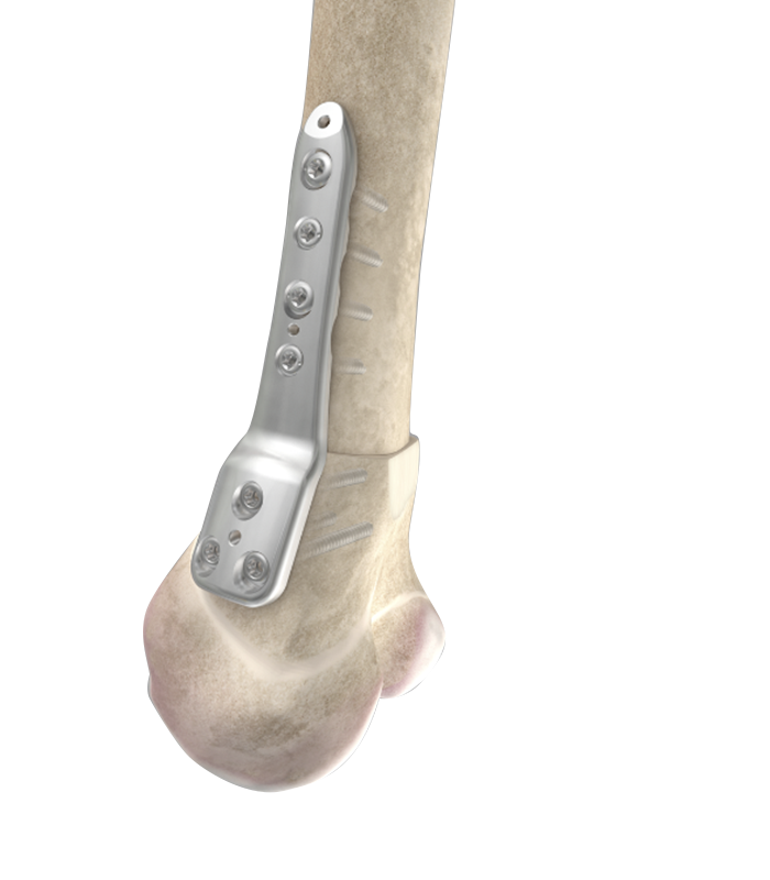 Osteotomias